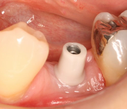 松本10　土台装着直後